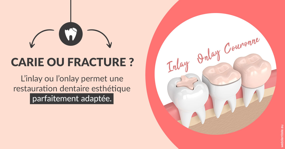 https://selarl-pascale-bonnefont.chirurgiens-dentistes.fr/T2 2023 - Carie ou fracture 2