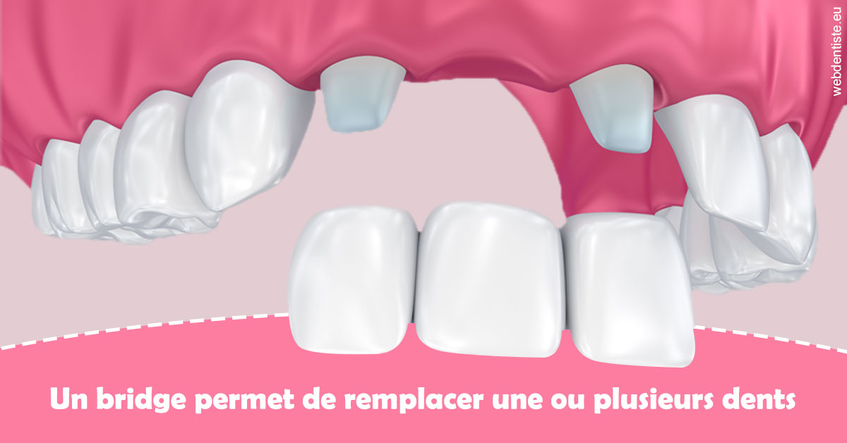 https://selarl-pascale-bonnefont.chirurgiens-dentistes.fr/Bridge remplacer dents 2