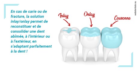 https://selarl-pascale-bonnefont.chirurgiens-dentistes.fr/L'INLAY ou l'ONLAY