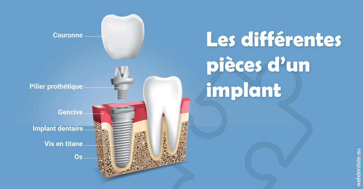 https://selarl-pascale-bonnefont.chirurgiens-dentistes.fr/Les différentes pièces d’un implant 1